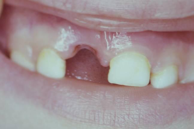 Dente avulsionado, dente permanente que saiu completamente
