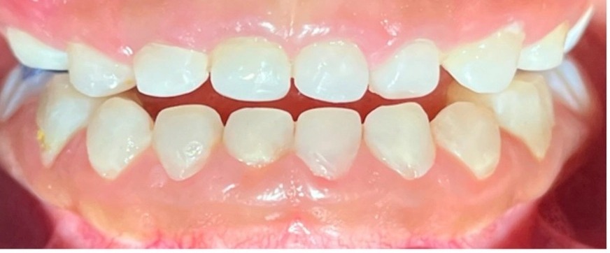 Vista frontal após reabilitação com coroas PMMA, mesma criança de 4 anos, dentes decíduos restaurados