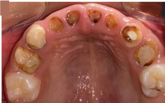 Vista dos dentes decíduos com lesões de cárie, fotografia reutilizada da página individual.