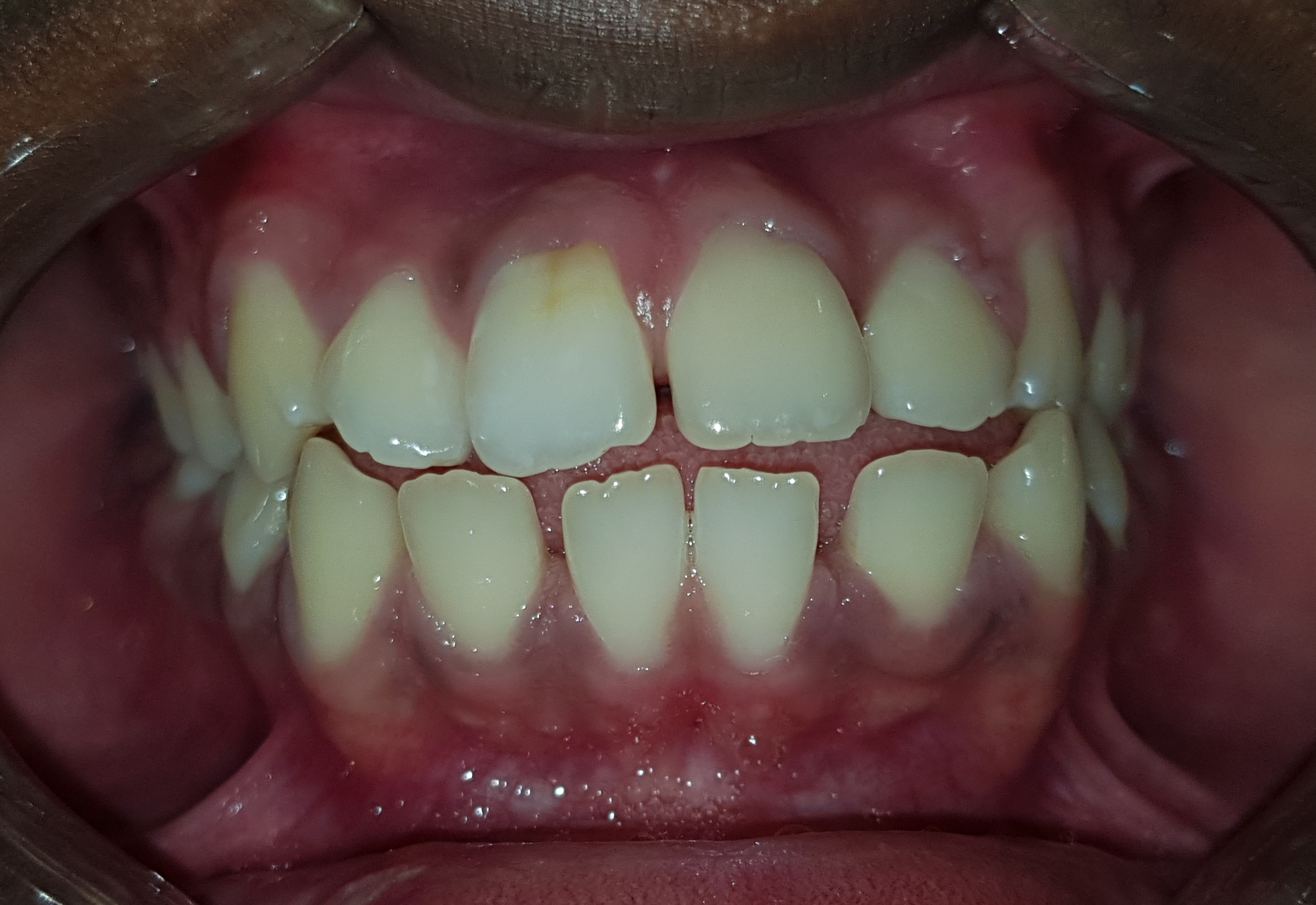Fotografia clínica de mordida aberta anterior