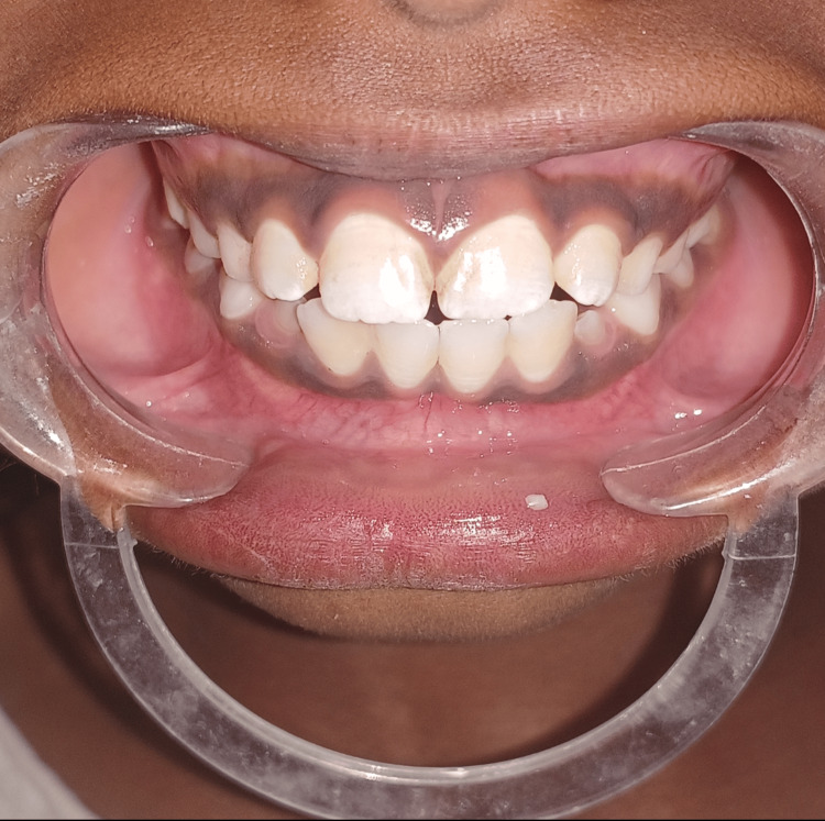 Mordida corrigida no mesmo paciente após tratamento com grade palatina, dentes frontais superiores e inferiores em oclusão normal
