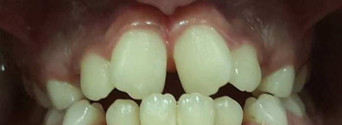 Mordida cruzada anterior, dentes superiores frontais posicionados atrás dos inferiores