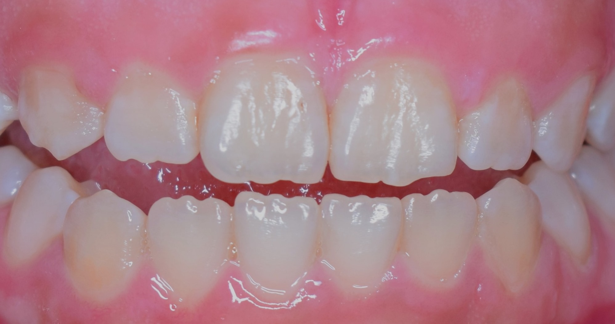 Esmalte íntegro, dentes saudáveis com estrutura mineralizada preservada, sem manchas ou lesões