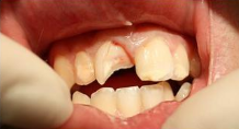 Fratura coronaria, incisivo com linha de fratura visivel e dentina exposta