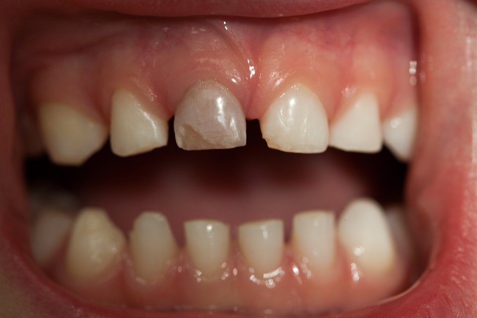 Dente decíduo com fratura de esmalte e escurecimento, segundo ângulo clínico