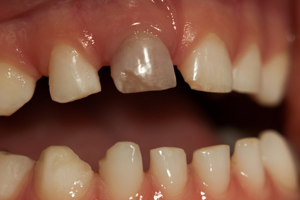 Dente decíduo com fratura de esmalte, fotografia reutilizada da página individual.